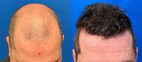 Hair Transplant Surgeon, Austin, Houston, San Antonio & Dallas, Texas.